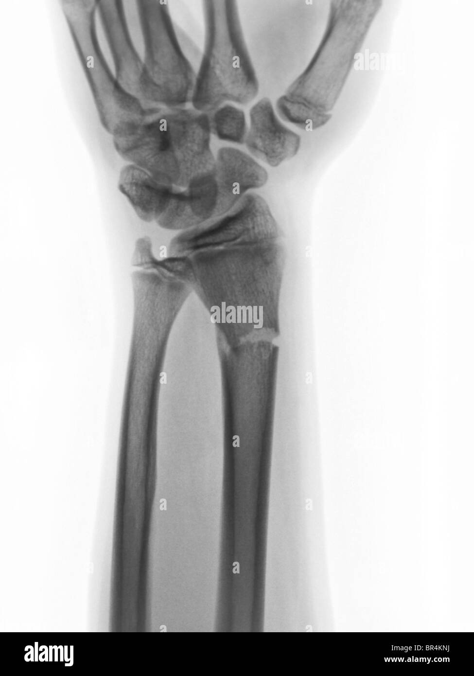 Avambraccio x-ray mostra un raggio distale di una frattura in un ragazzo di quattordici anni Foto Stock