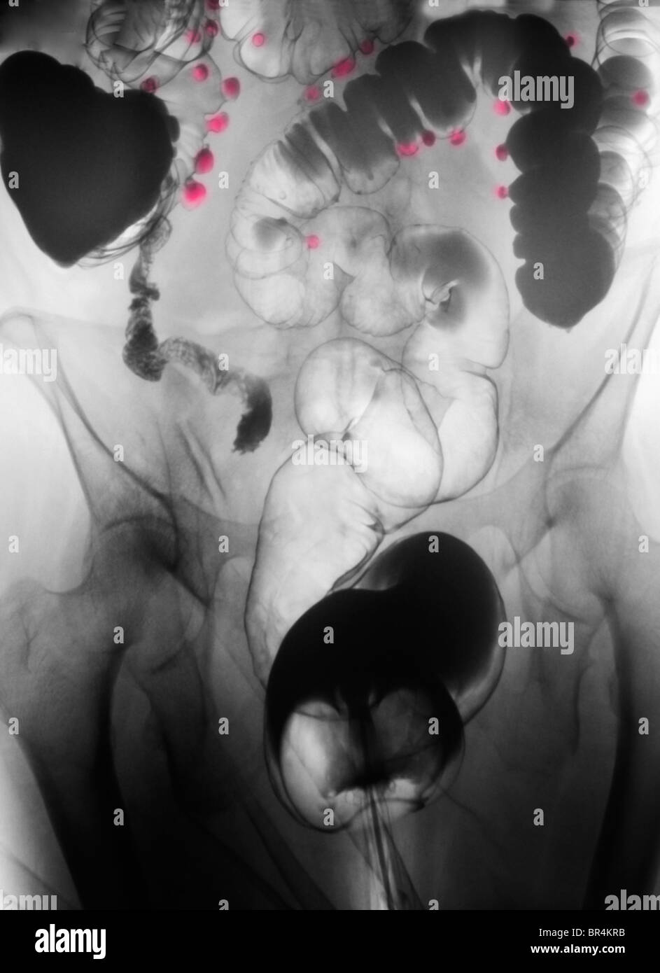Addome x-ray del bario esame di contrasto che mostra la diverticolosi del colon di un 67 anno vecchia donna Foto Stock