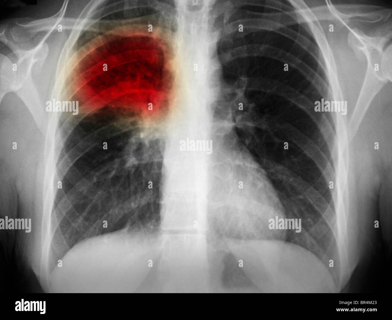 I raggi x al torace che mostra la polmonite del lobo superiore del polmone di 17 anno vecchia donna Foto Stock