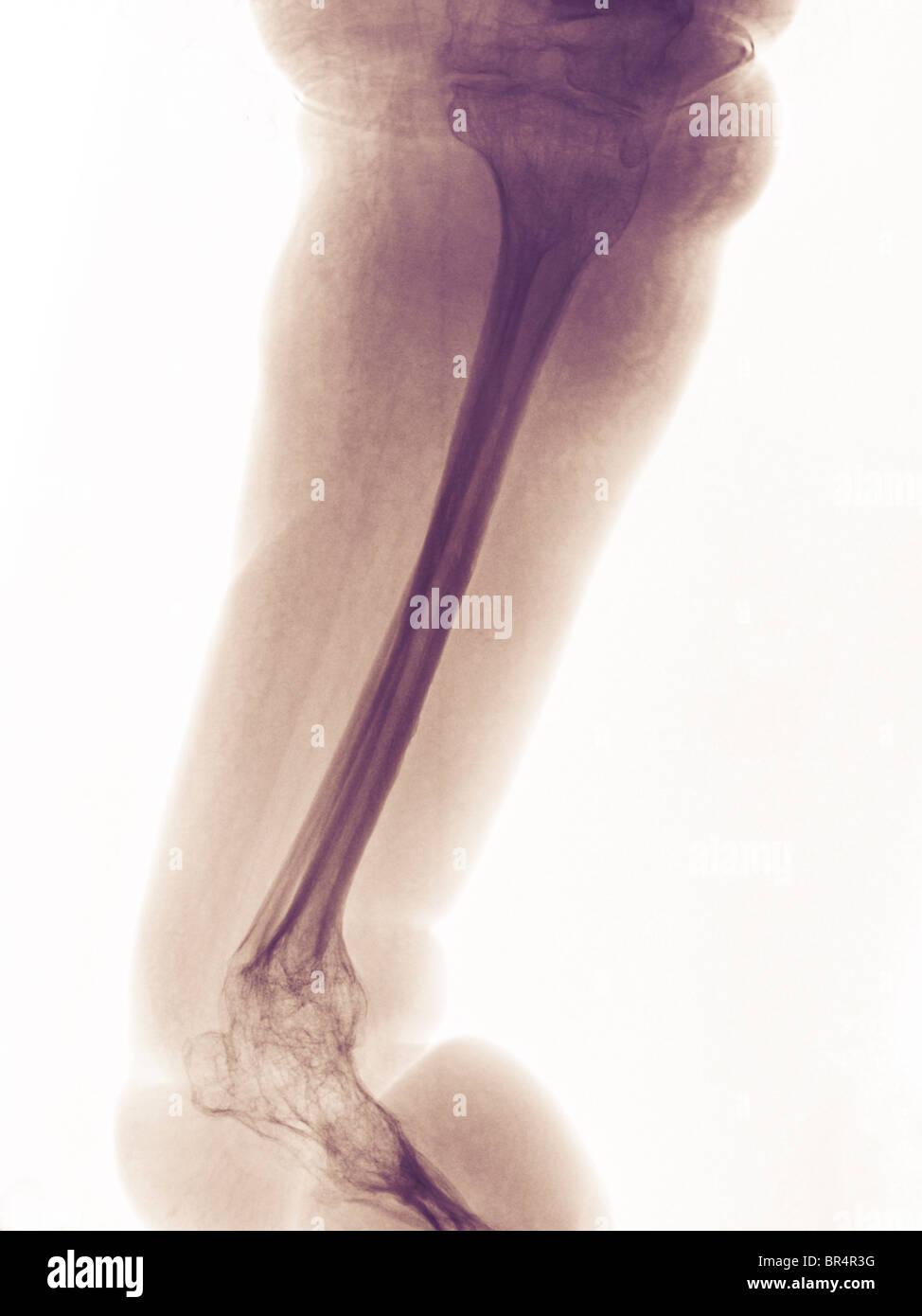 La gamba e il piede x-ray di 63 anno vecchio con la paraplegia e ampie variazioni degenerative e osteopenia Foto Stock