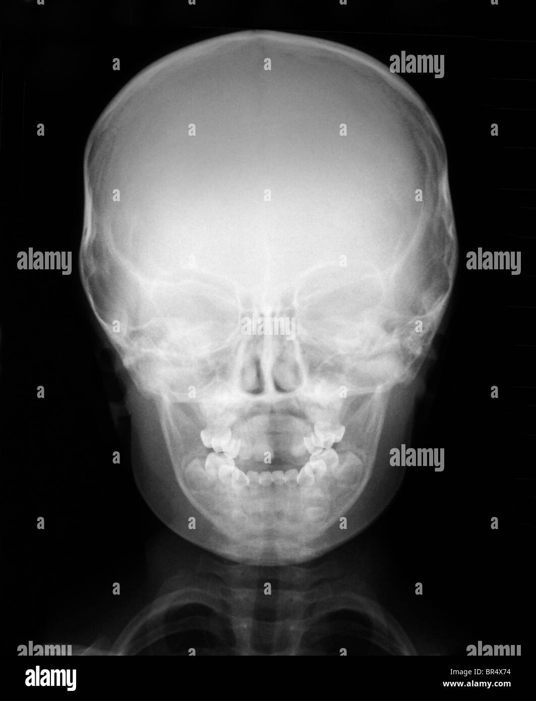 Il normale x-ray della testa di un bambino di 3 anni ragazzo, raggi x della testa e del torace di un 3 anno vecchio ragazzo Foto Stock
