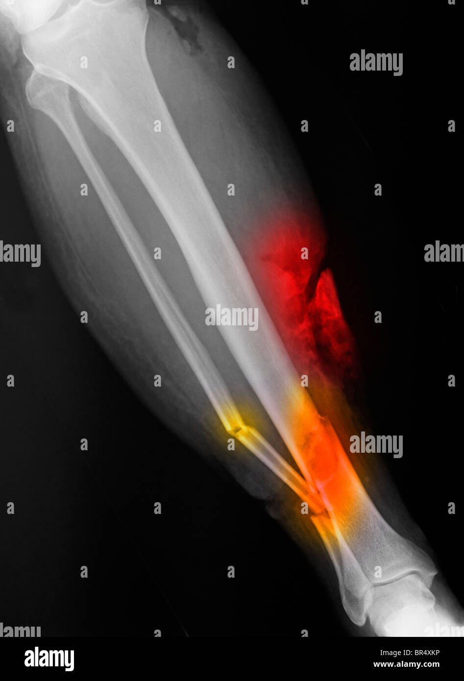 Raggi X che mostra un open tibia e perone frattura della parte inferiore della gamba di un 65 anno vecchio uomo coinvolto in un incidente in moto Foto Stock
