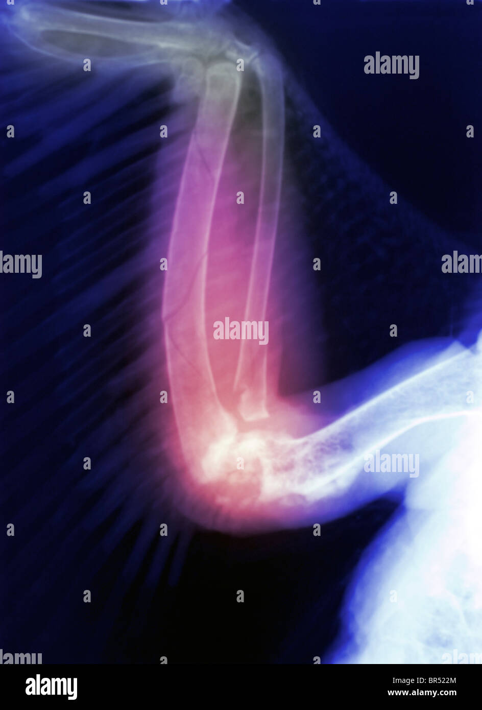 Raggi x di un parafango rotto di un wild Turchia che è stato colpito da un auto Foto Stock