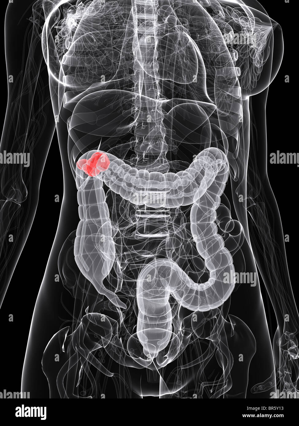 tumore del colon Foto Stock