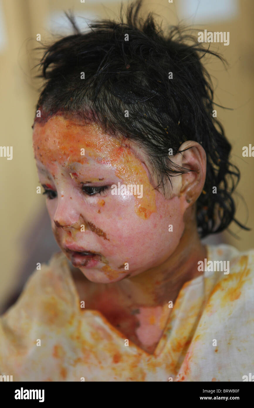 Masterizzare le vittime di un attacco di IED in Afghanistan Foto Stock