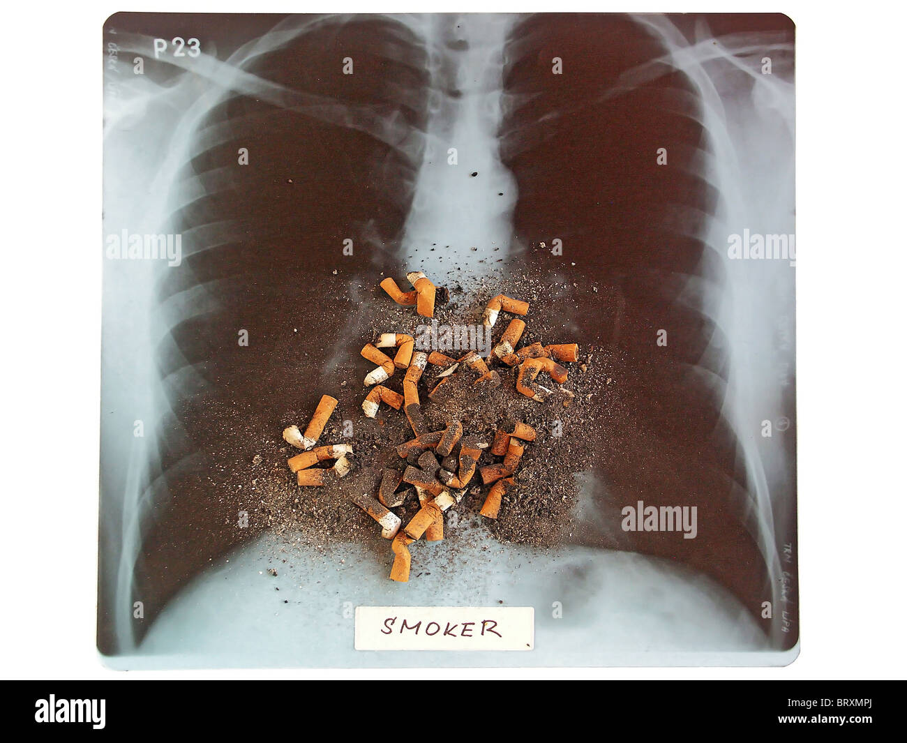 Radiografia fumatore Foto Stock