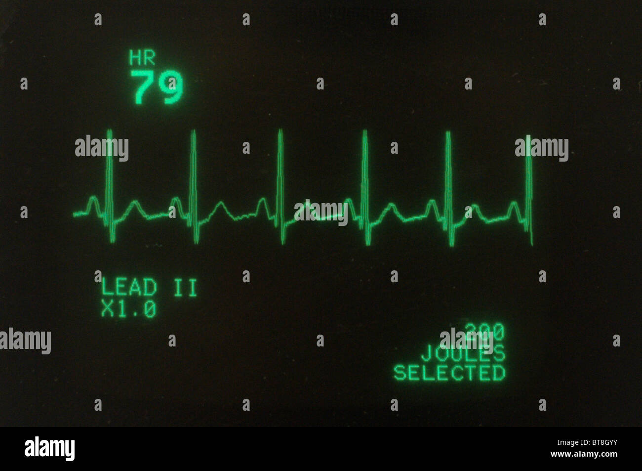 Heart monitor screen immagini e fotografie stock ad alta risoluzione - Alamy