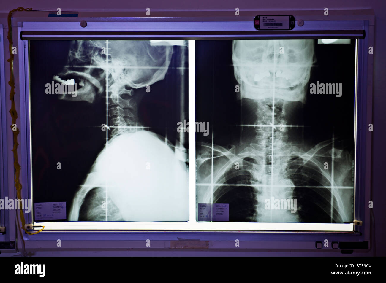 X-ray di umana della testa e del collo Foto Stock