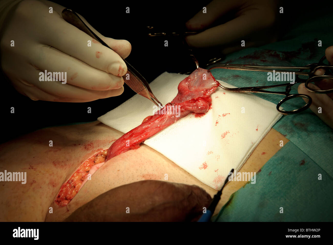 Tumore testicolare intervento di rimozione, urologia Foto Stock