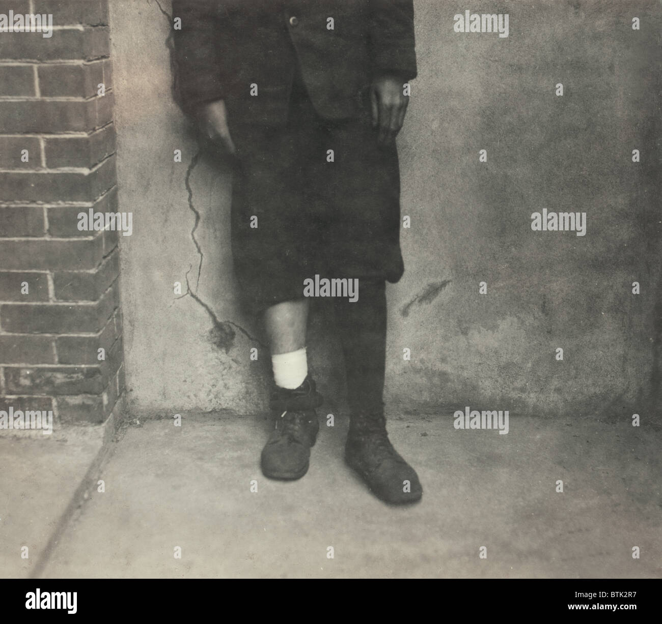 Il lavoro minorile, Wilfred Levoie, 15 anni, American biancheria Company, stava spingendo e tirando cesto lungo il pavimento; cestello catturati allentato un bordo e lo gettarono contro il telaio il taglio la sua gamba off, Fall River, Massachusetts, fotografia di Lewis Wickes Hine, fotografia, 22 giugno 1916. Foto Stock