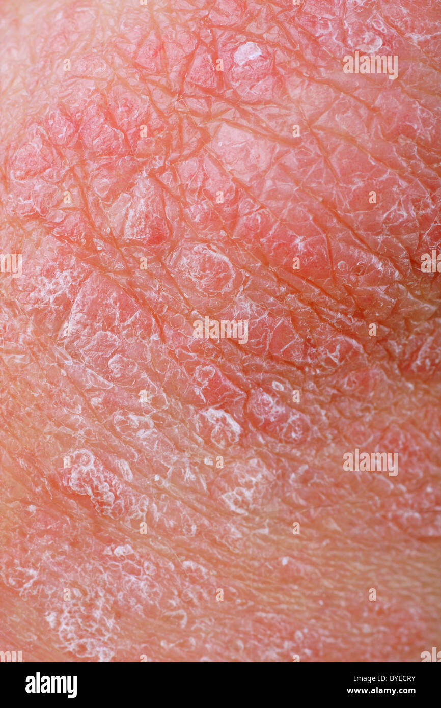 Close-up di un gomito di pazienti che mostrano le placche di pelle secca vengono tipicamente osservati con la psoriasi Foto Stock