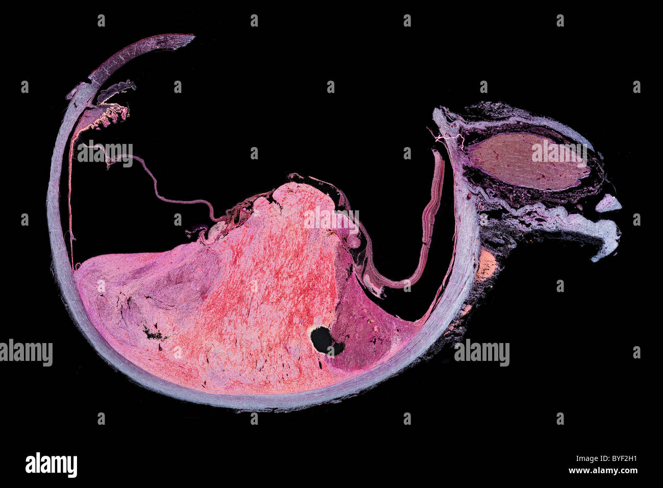 Campo oscuro fotomicrografia, occhio umano sezione con tumore melanotic Foto Stock