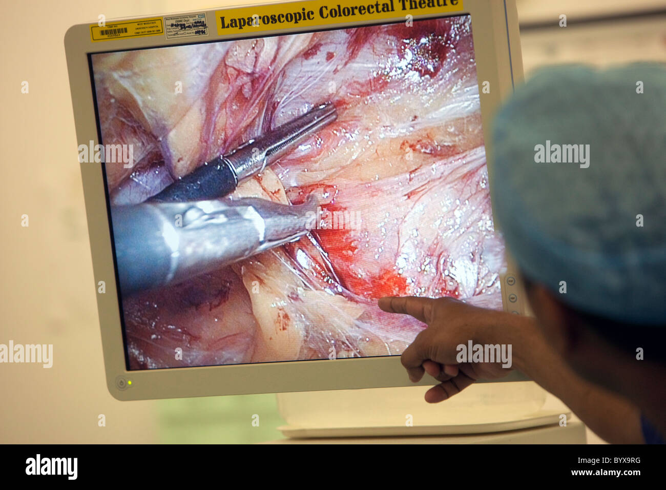Laparoscopica chirurgia colorettale Foto Stock