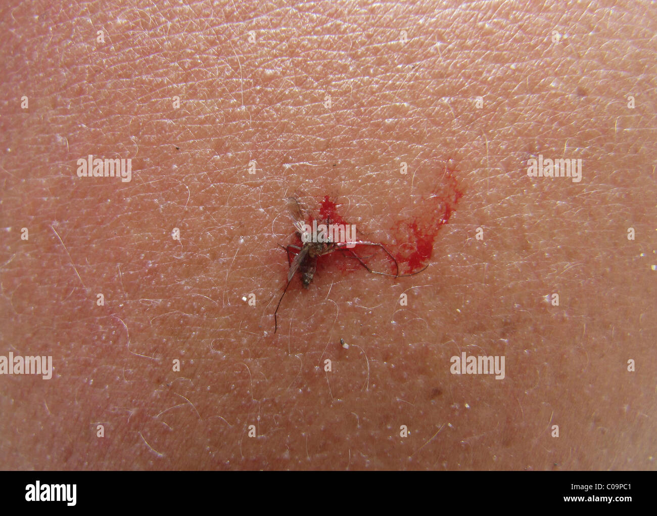 Zanzara morta (Culicidae) schiacciati sulla pelle umana Foto Stock
