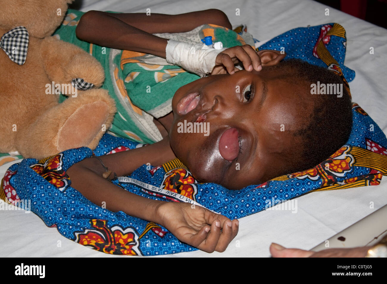 Giovane ragazzo africano con gravi sintomi di cancro Burkitts Ospedale litorale Mombasa Kenya Foto Stock