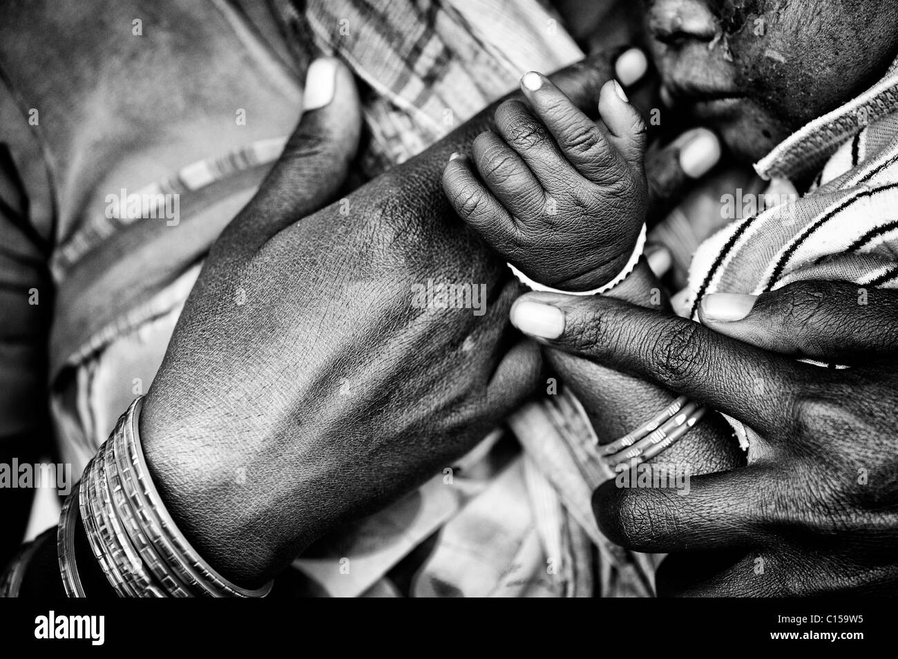 Indian madri mano che trattiene la sua mano per neonati. Il bambino ha un viso grave disturbo della pelle. Andhra Pradseh India. In bianco e nero Foto Stock