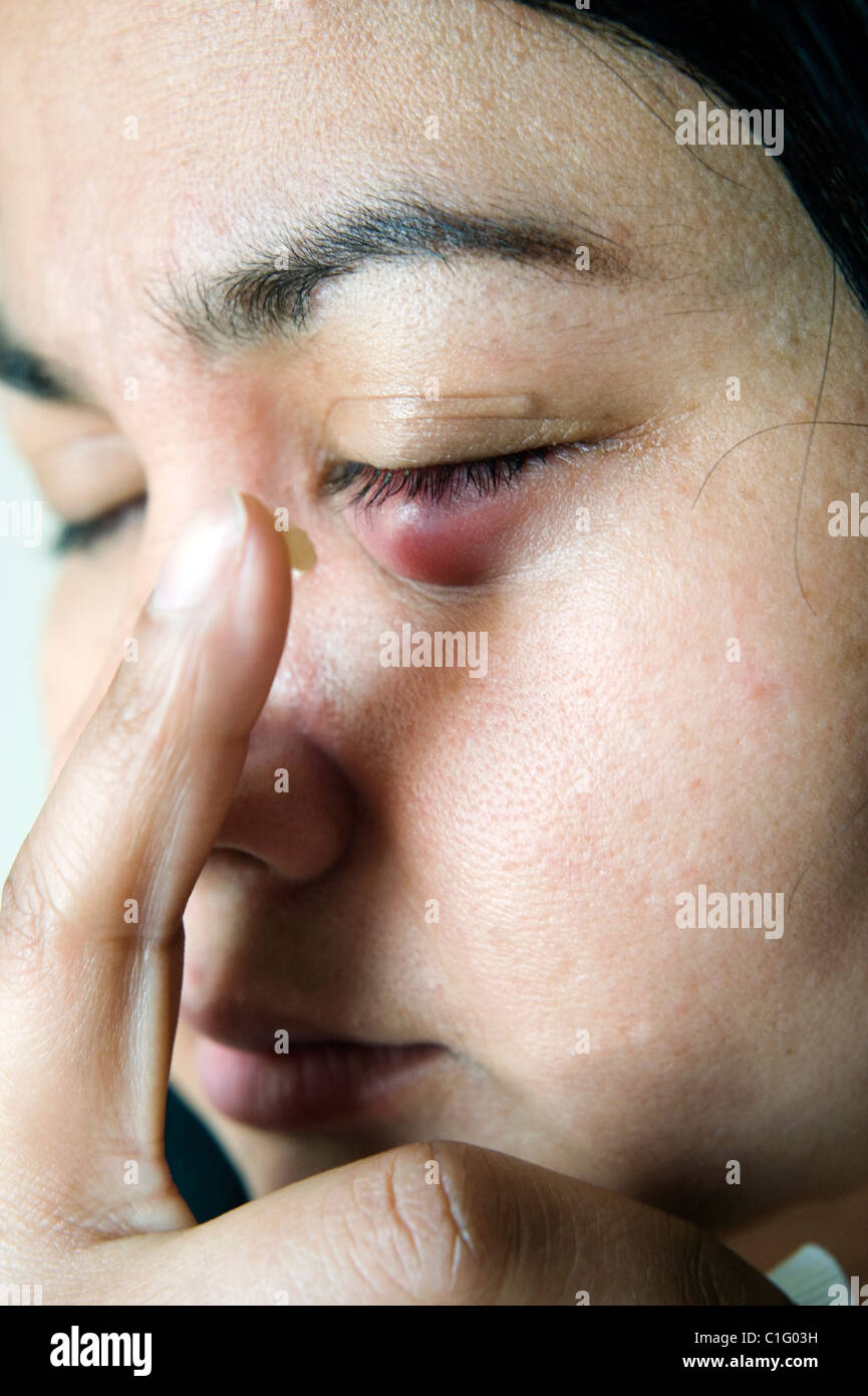 Donna l'applicazione di crema medicinale ad un stye sul suo occhio Foto Stock