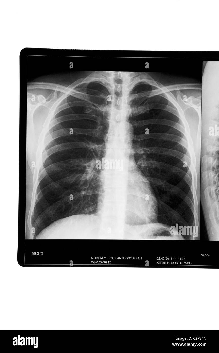 Raggi x dei polmoni Foto Stock