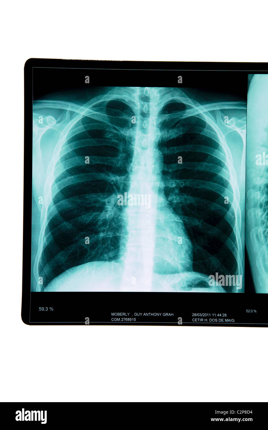 Raggi x dei polmoni Foto Stock
