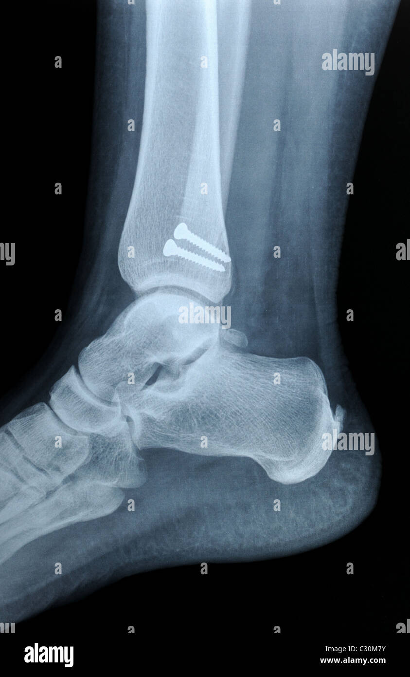 Autentica x-ray immagine della frattura umana perone osso con viti in metallo Foto Stock