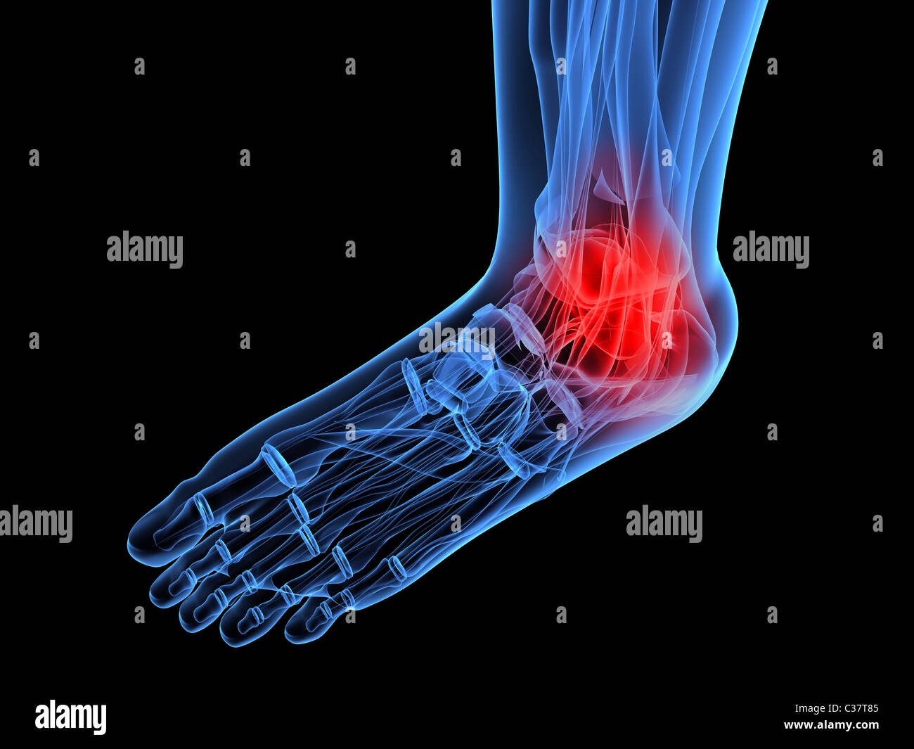 X-ray piede - dolorosa caviglia Foto Stock