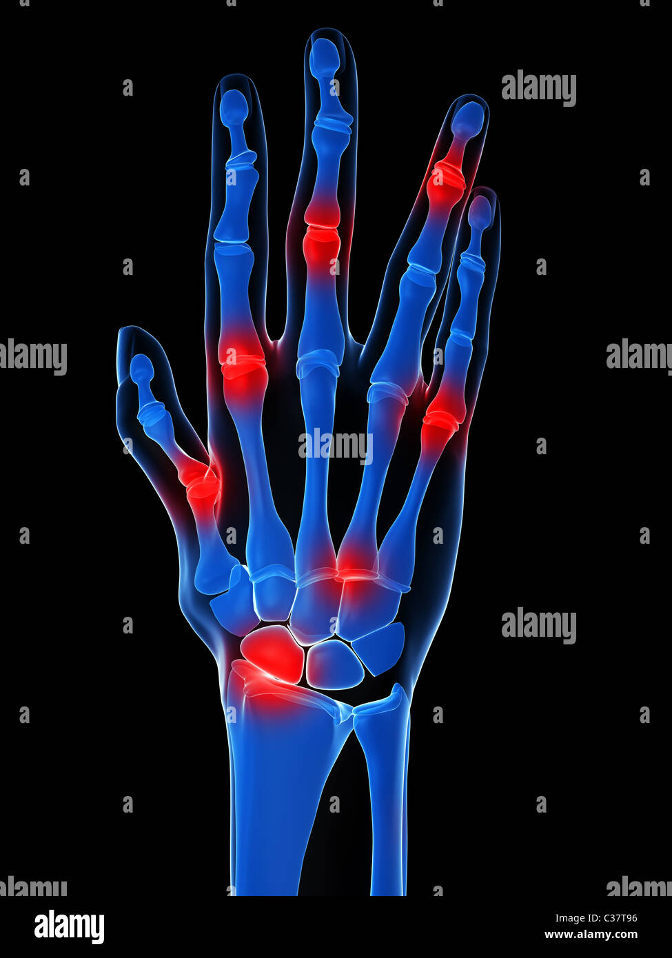 Mano umana - artrite Foto Stock