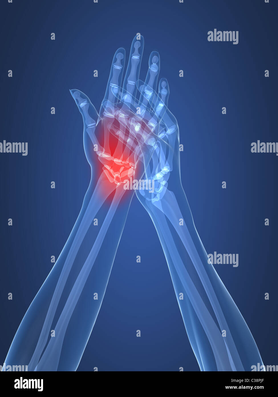 X-ray mani - artrite Foto Stock