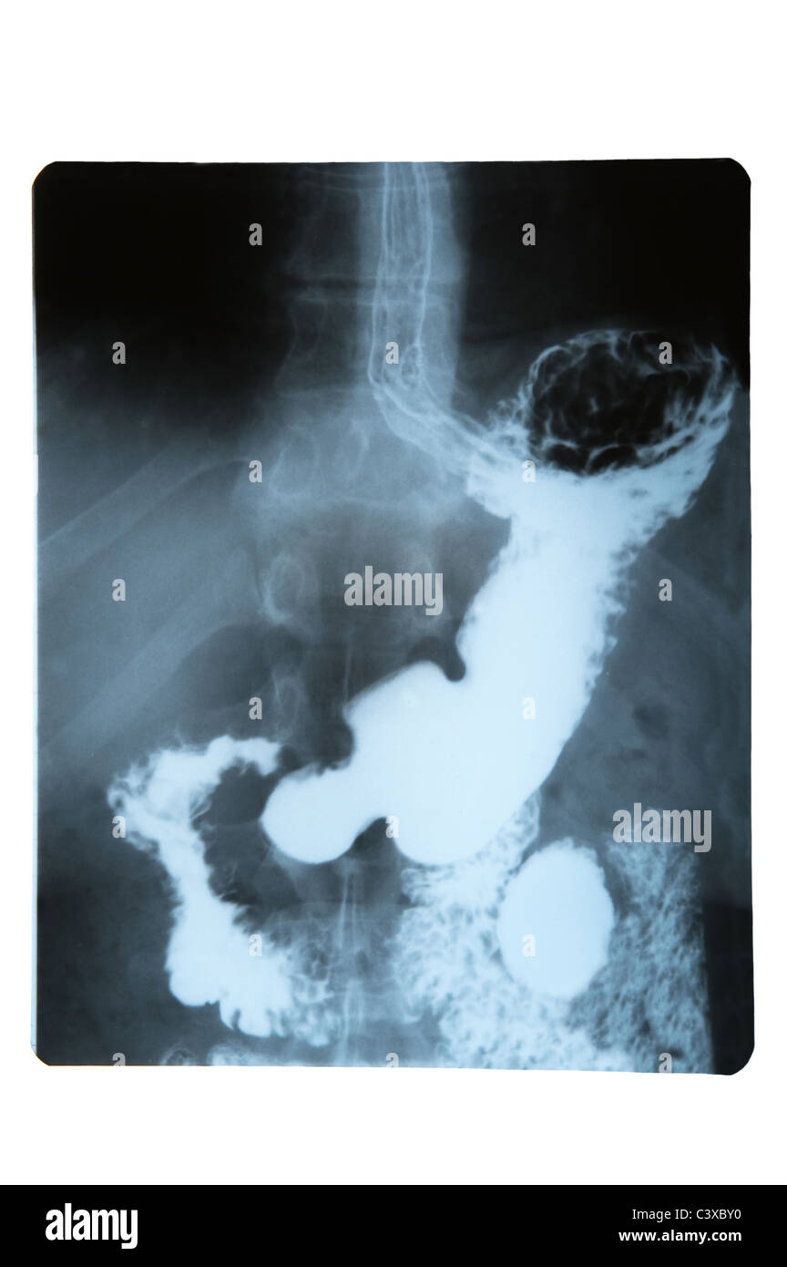 Oggetto su bianco - immagine a raggi X di stomaco Foto Stock Oggetto su bianco - immagine a raggi X di stomaco Foto Stock