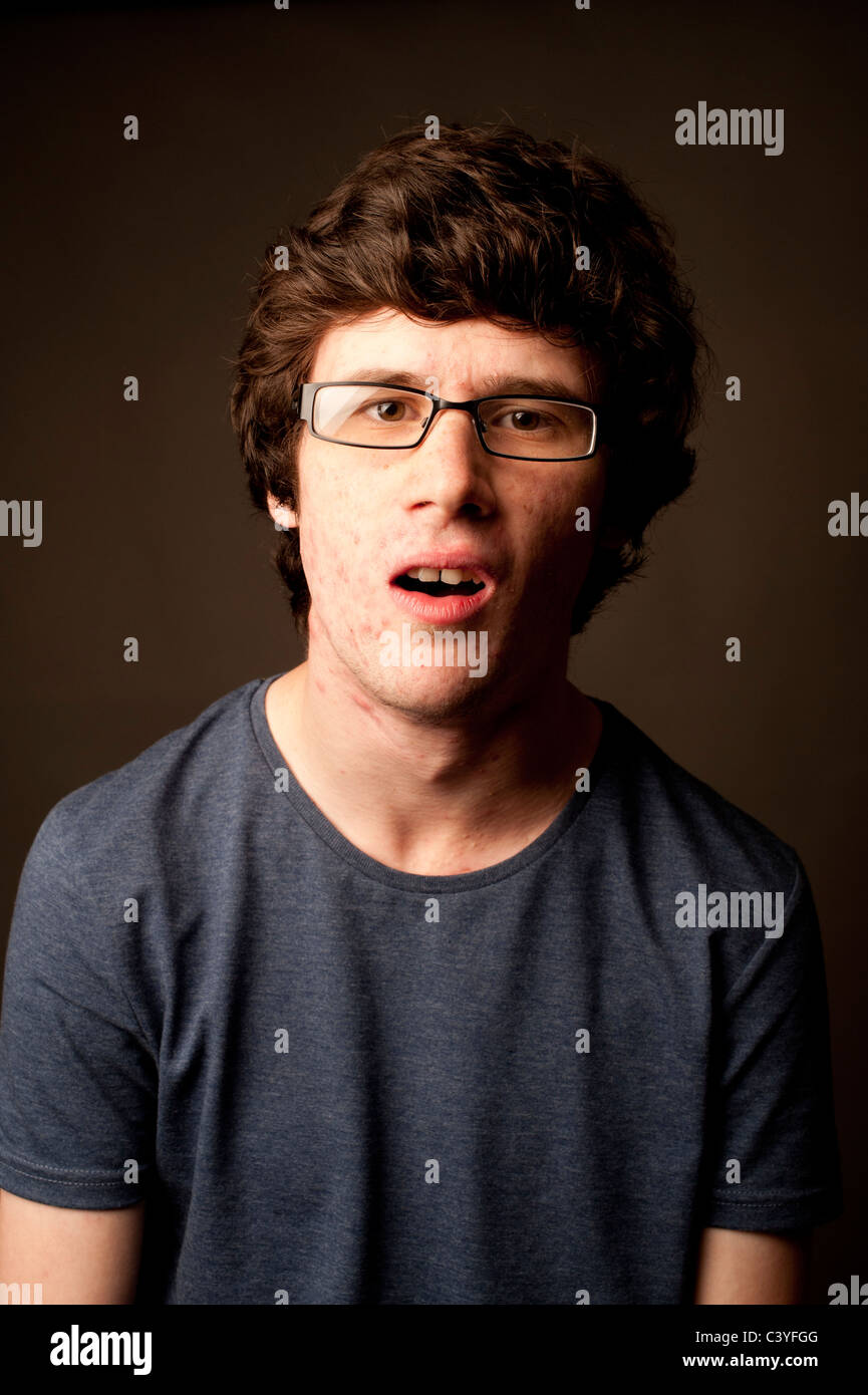 Un macchie di fronte giovane adolescente di gioventù con acne cattivo colorito della pelle che indossano occhiali nerd geek geeky giovani maschi adulti, REGNO UNITO Foto Stock