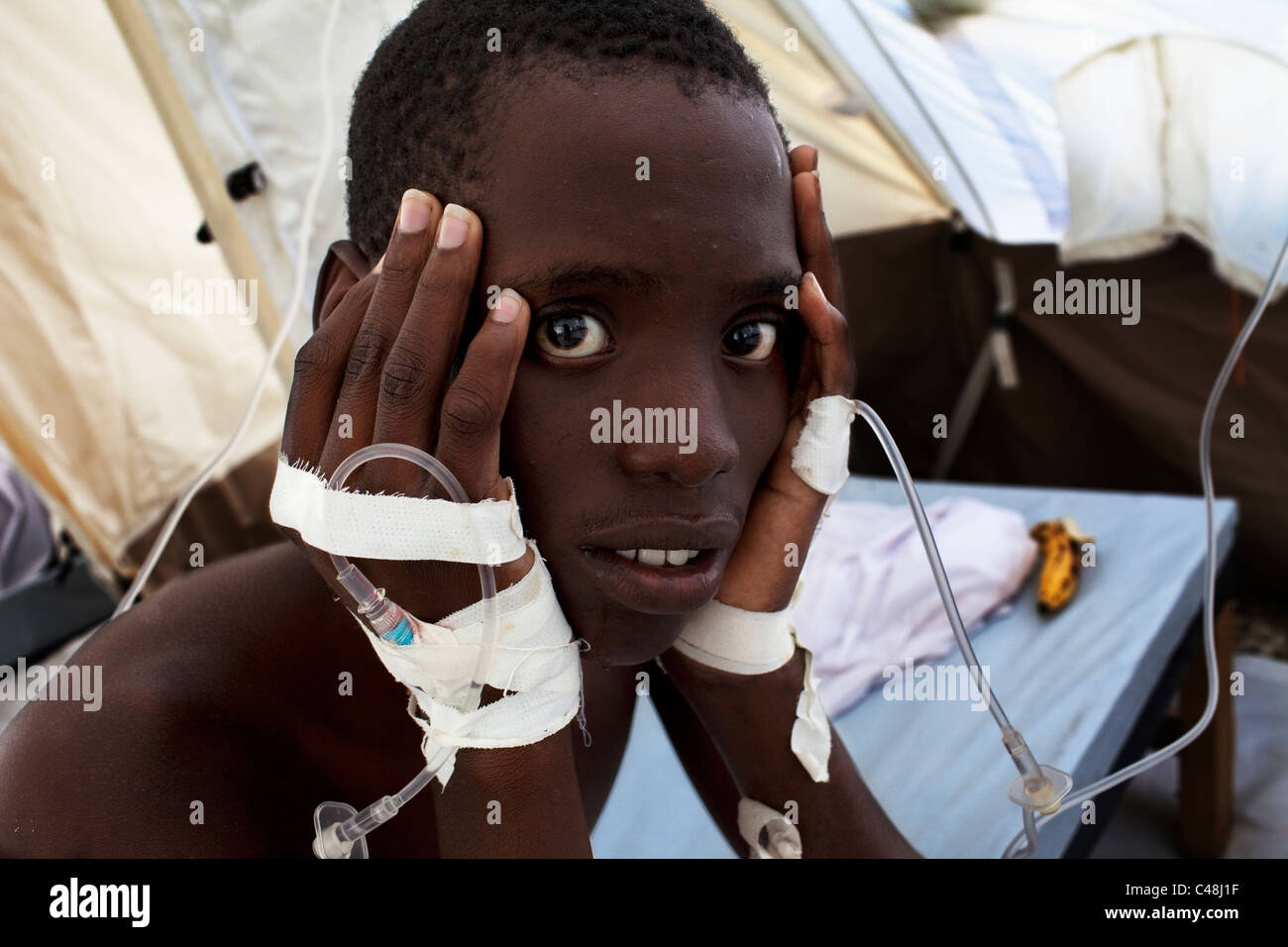 Giovane paziente di colera con l'espressione del viso. Foto Stock