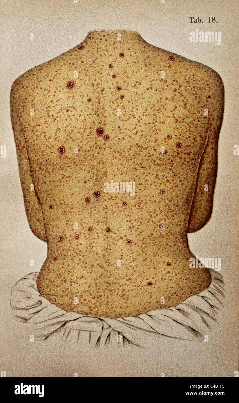 Illustrazione di Syphilitic papule sulla pelle umana Foto Stock