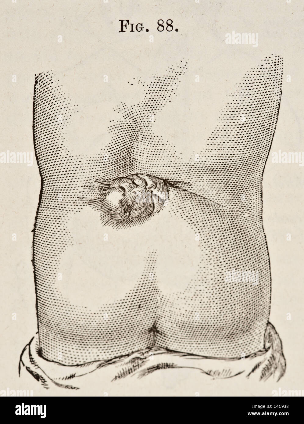 Antica Illustrazione medica raffigurante la Spina Bifida circa 1881 Foto Stock