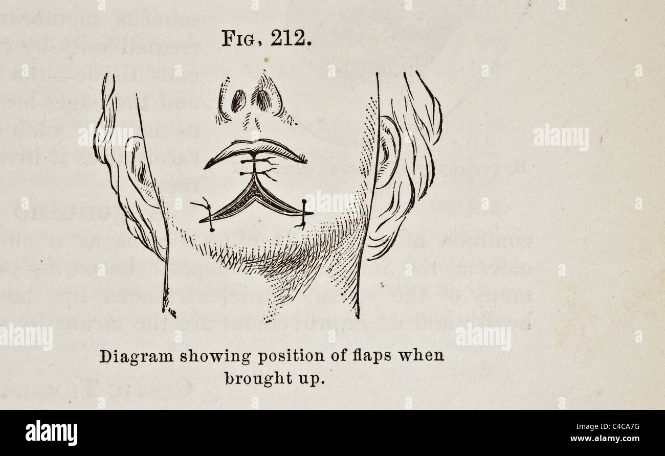 Antica Illustrazione medica di affezioni delle labbra e della bocca circa 1881 Foto Stock