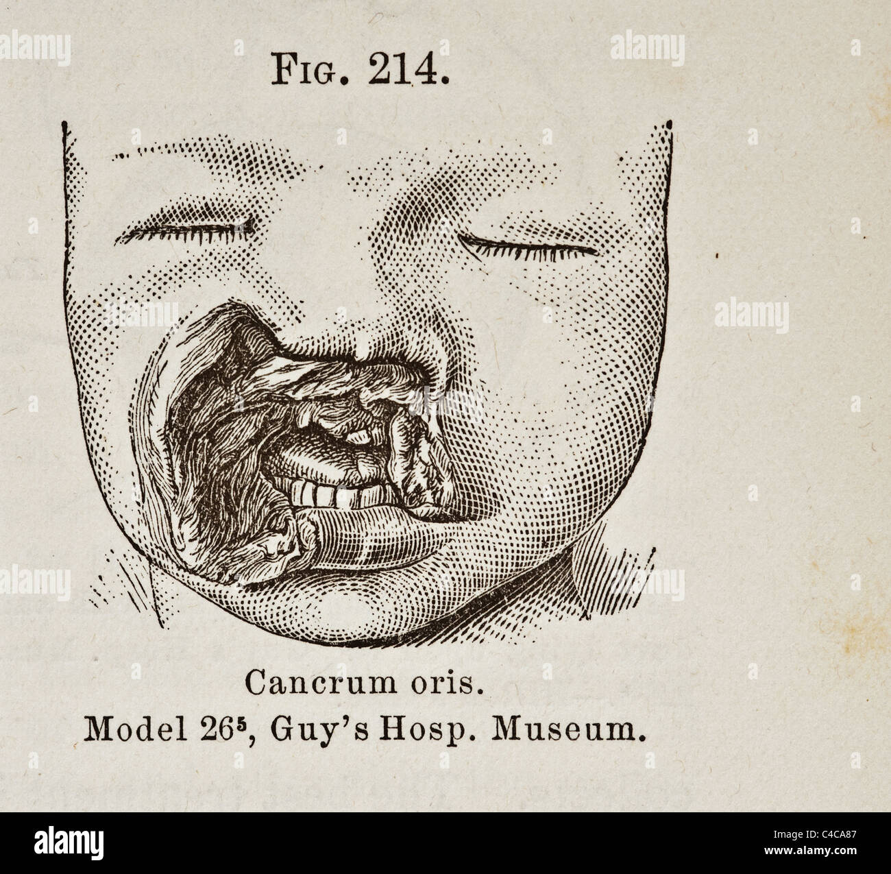 Antica Illustrazione medica di affezioni delle labbra e della bocca circa 1881 Foto Stock