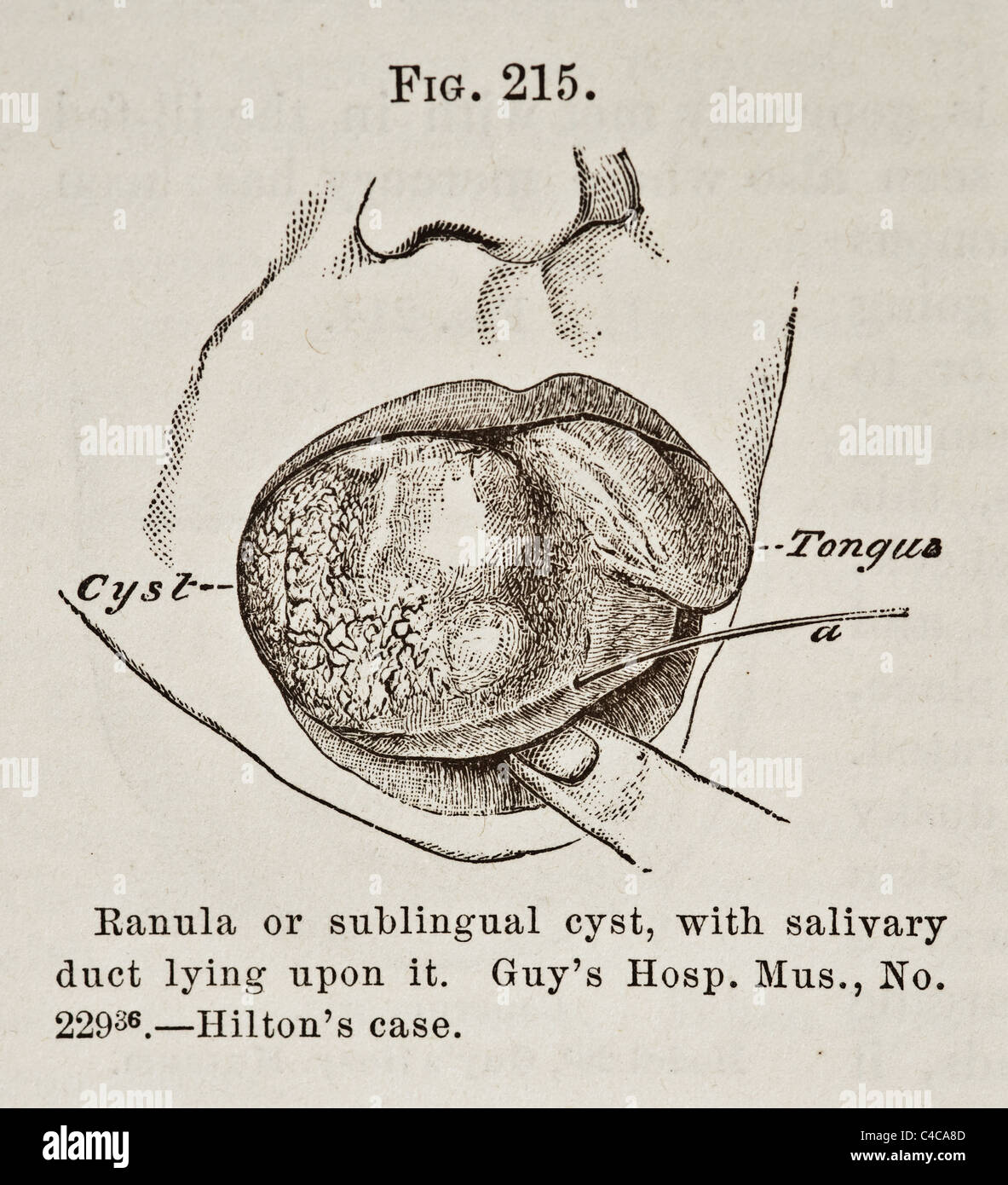 Antica Illustrazione medica di affezioni delle labbra e della bocca circa 1881 Foto Stock