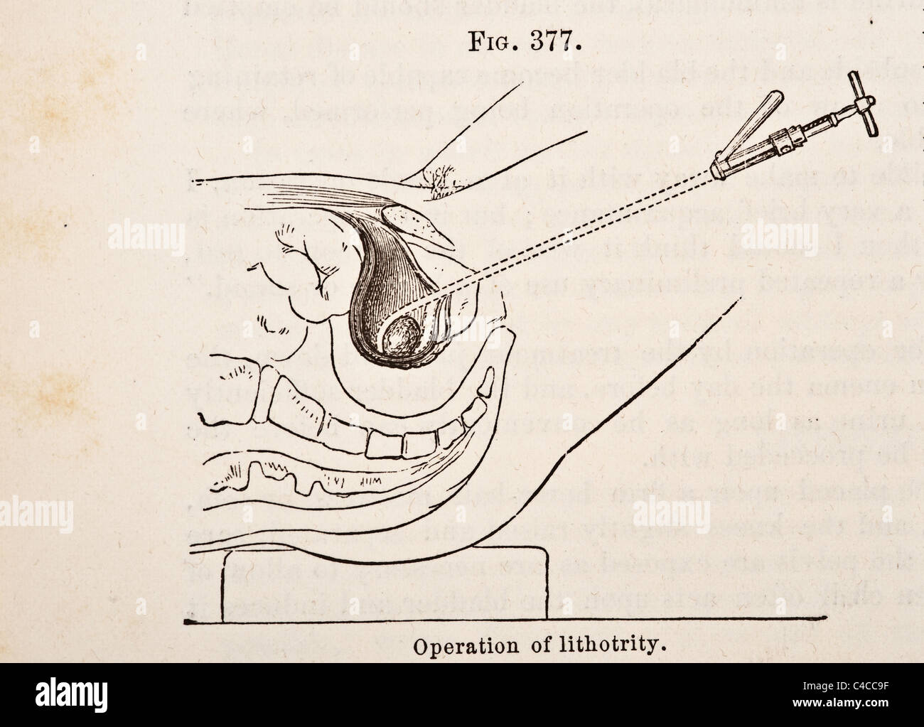 Antica Illustrazione medica di litotomia circa 1881 Foto Stock