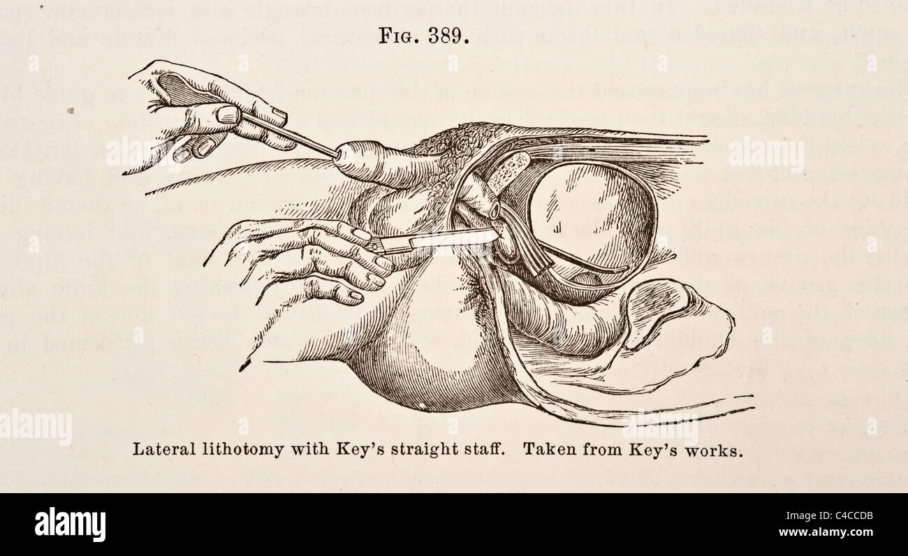 Antica Illustrazione medica di litotomia circa 1881 Foto Stock