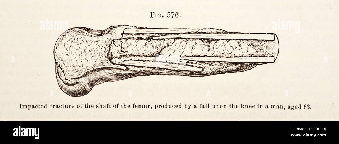 Antica Illustrazione medica del femore risalente al 1881 Foto Stock