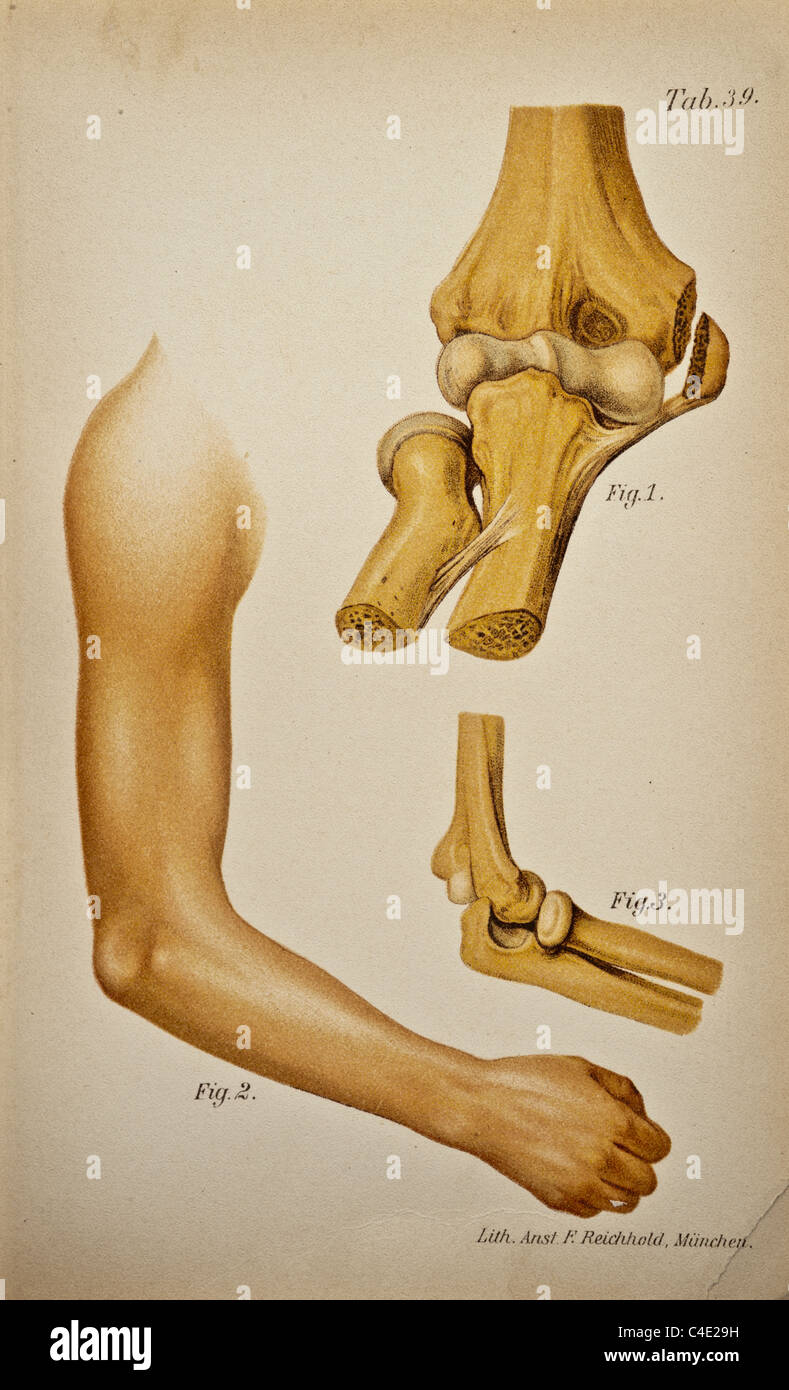 Antica Illustrazione medica di un dislocato avambraccio; circa 1902 Foto Stock