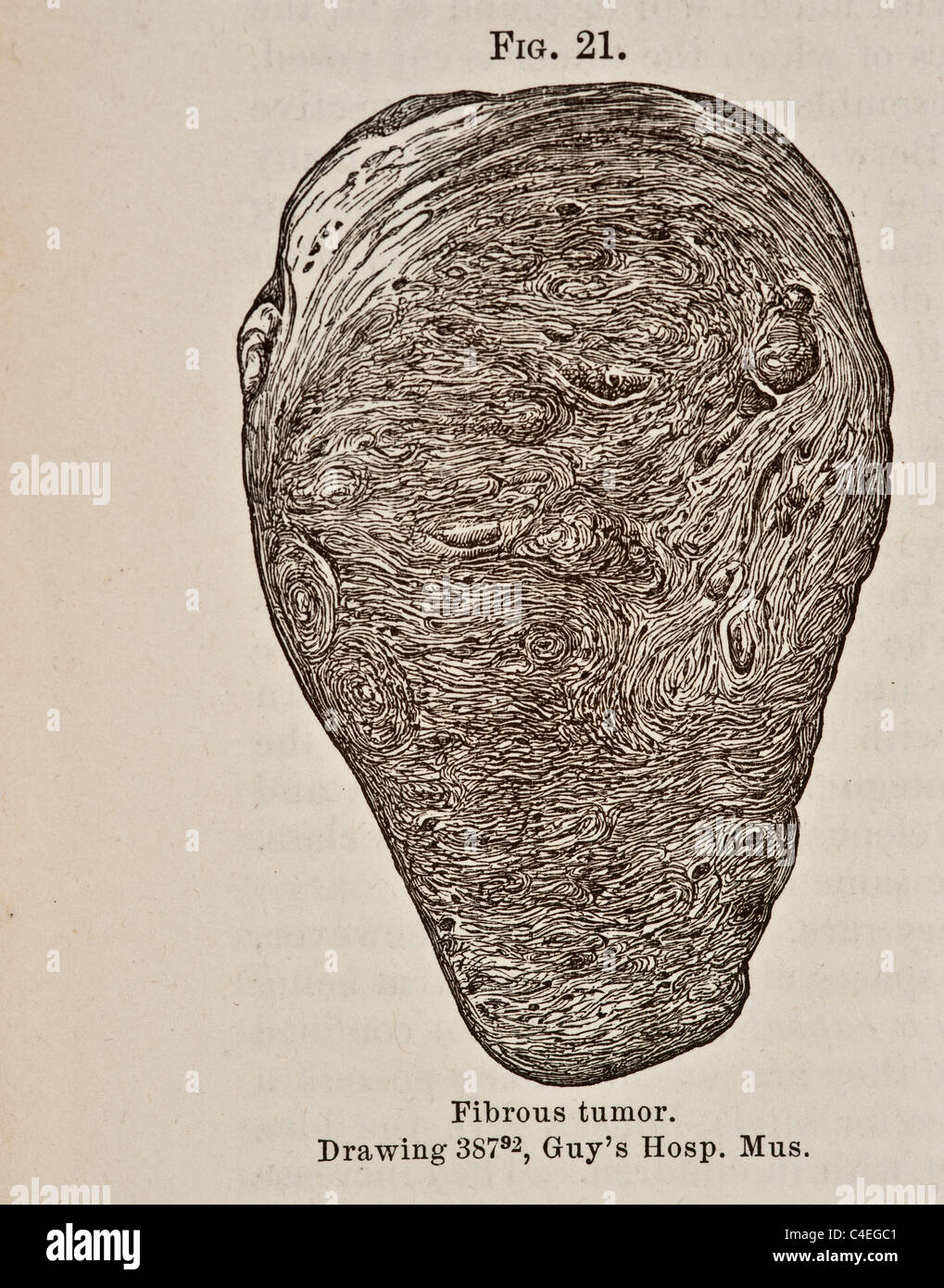 Antica Illustrazione medica del tumore fibroso circa 1881 Foto Stock
