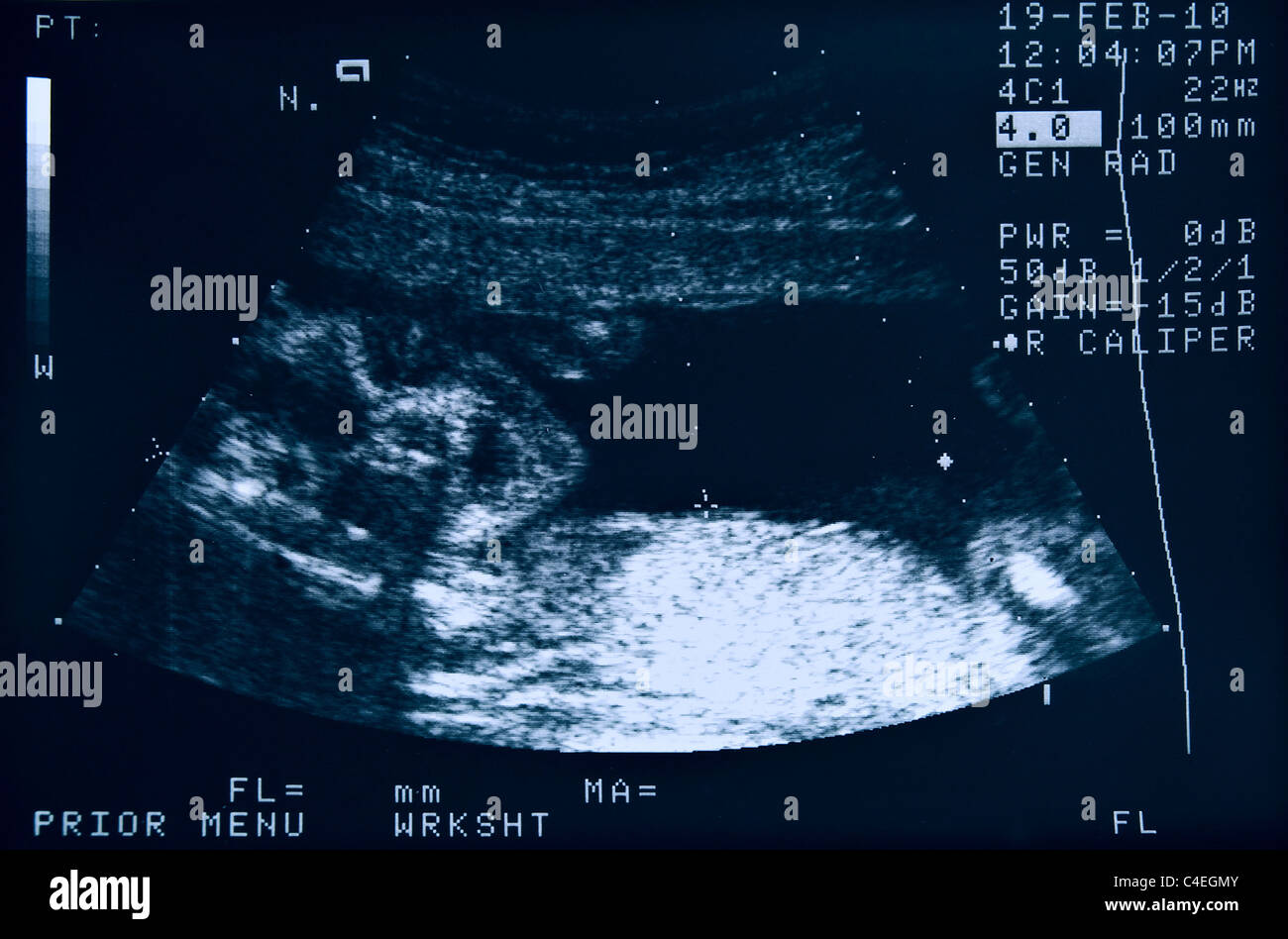 Ecografia di un feto a 22 settimane Foto Stock