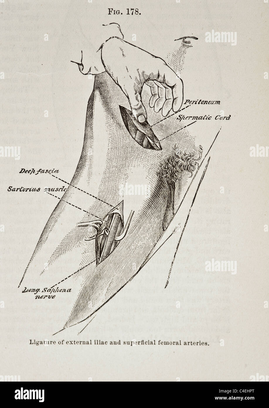 Antica Illustrazione medica di legatura dell'iliaca esterna e superficiale arterie femorali circa 1881 Foto Stock