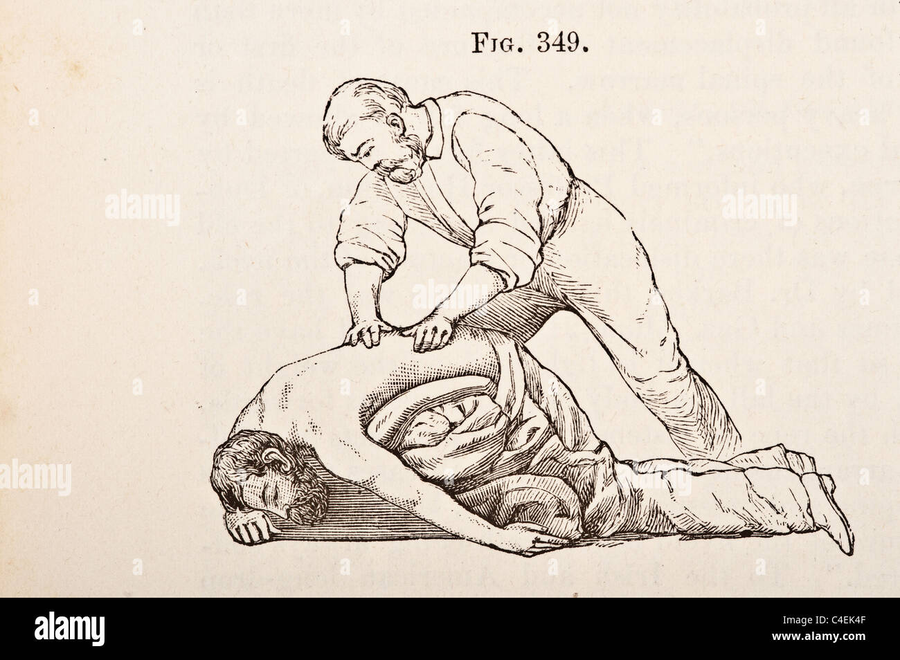 Antica Illustrazione medica di respirazione artificiale circa 1881 Foto Stock