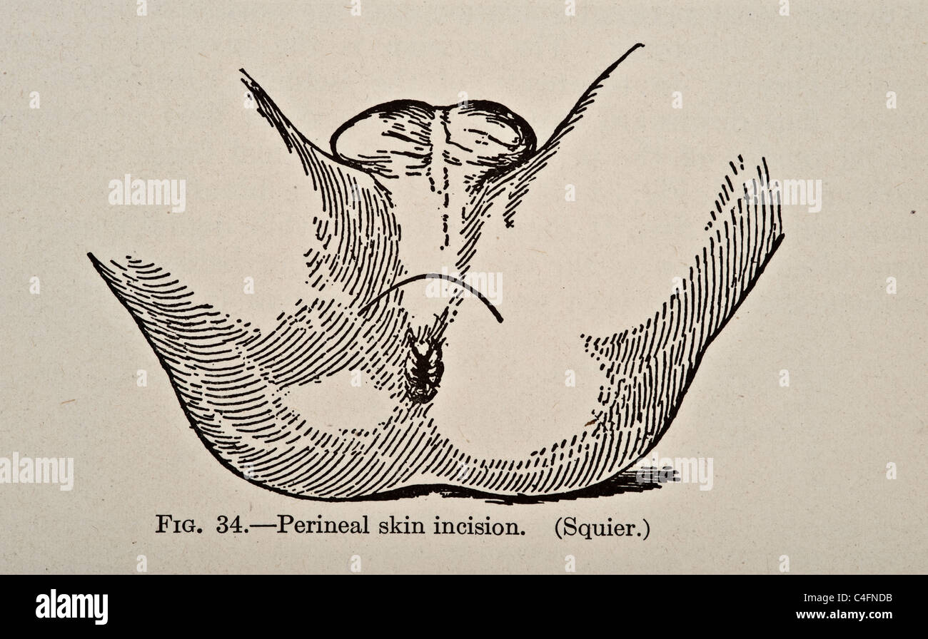 Urology di uomini donne e bambini da parte di Victor Pedersen copyright 1919 cistoscopia malattie malattia disturbo infezioni infezione procedura operativa di chirurgia sessuale tratto urinario uretroscopia urologo urologia Foto Stock