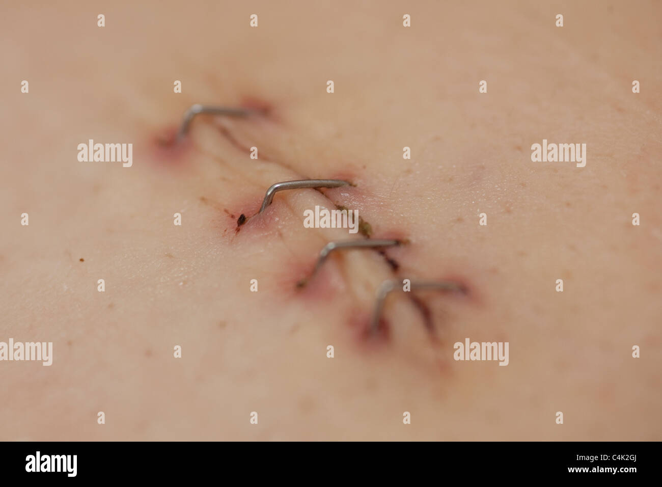 Laparoscopiche cicatrice di funzionamento da una colecistectomia tenuti insieme per guarire con punti metallici Foto Stock