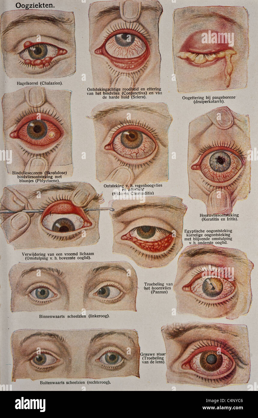 Antica Illustrazione medica della malattia oculare e chirurgia oftalmologo Foto Stock