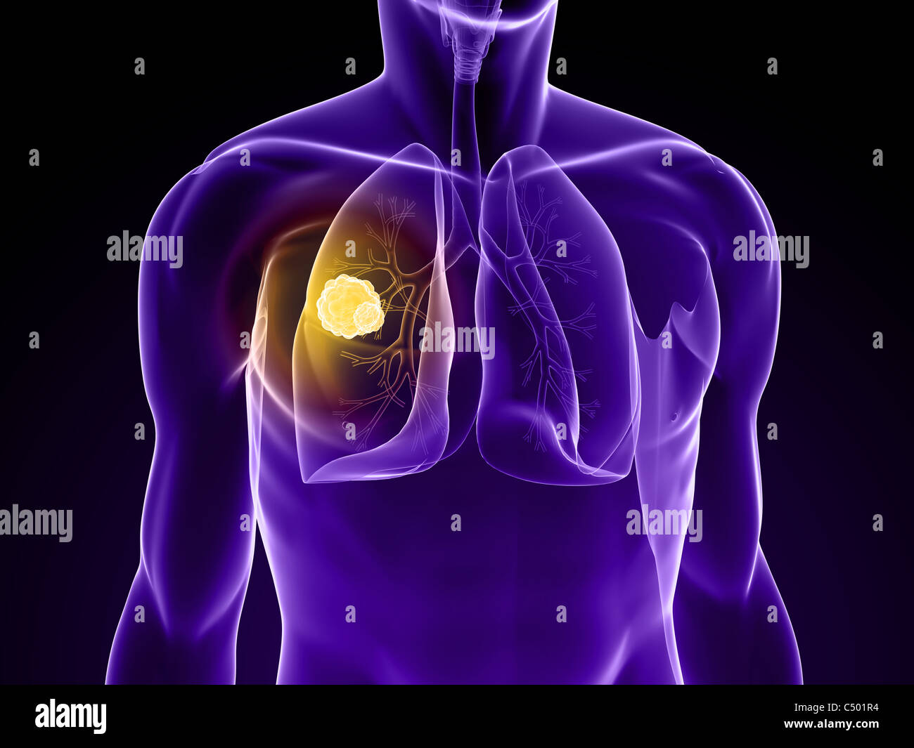 cancro del polmone Foto Stock