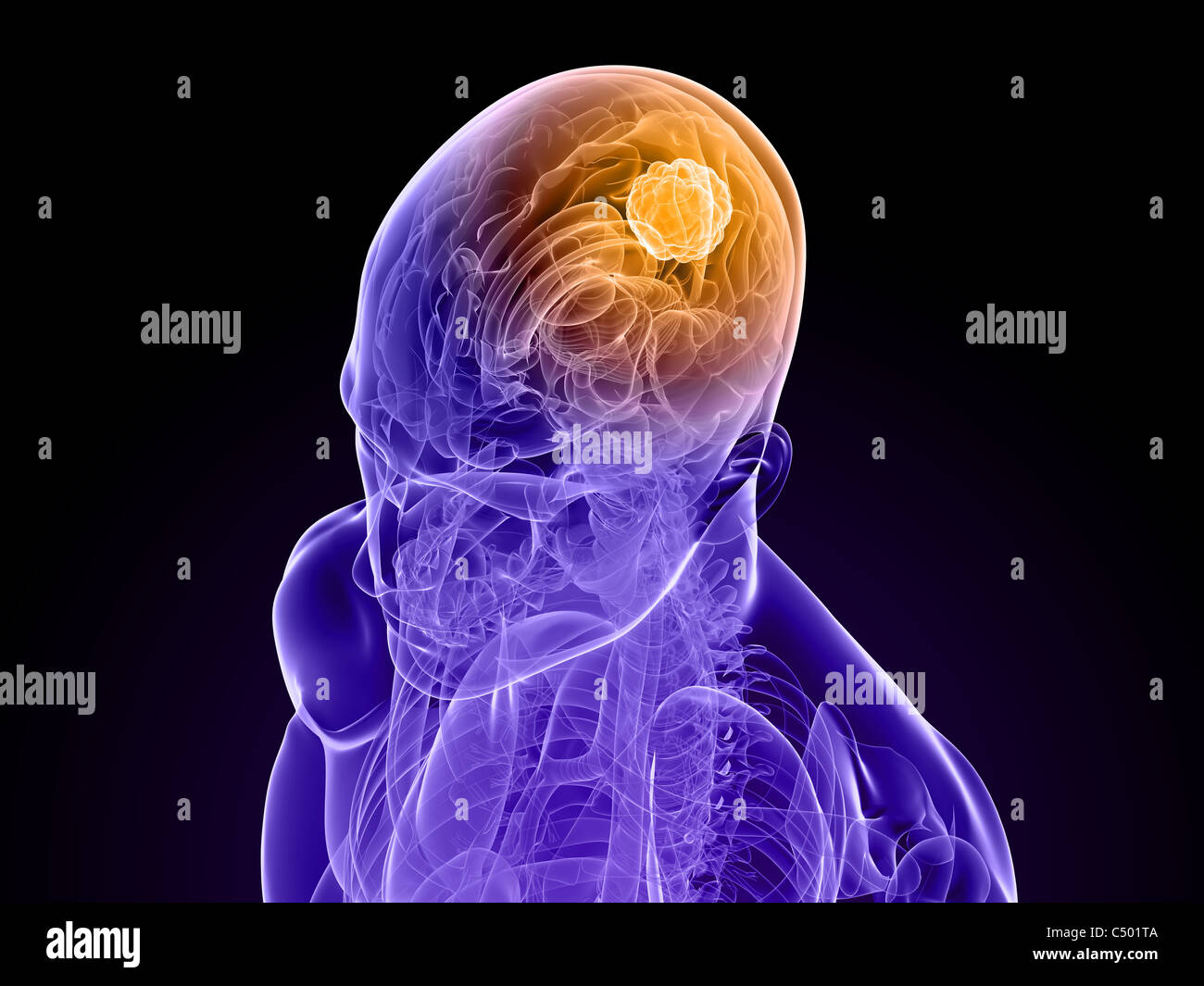 tumore cerebrale Foto Stock