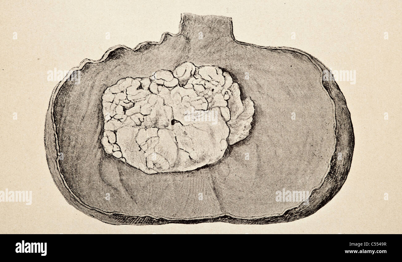 Anatomia di malattie intestinali tra cui il cancro Foto Stock