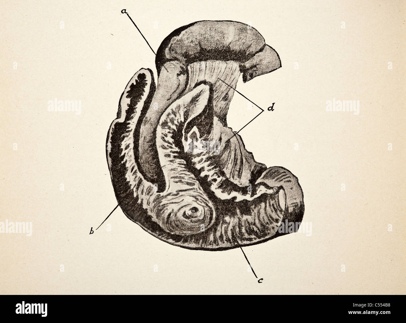 Anatomia di malattie intestinali tra cui il cancro Foto Stock